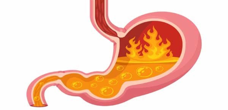 Health care Acid Reflux and GERD: Your Comprehensive Guide